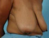 Patient # 32675 Before Photo # 3